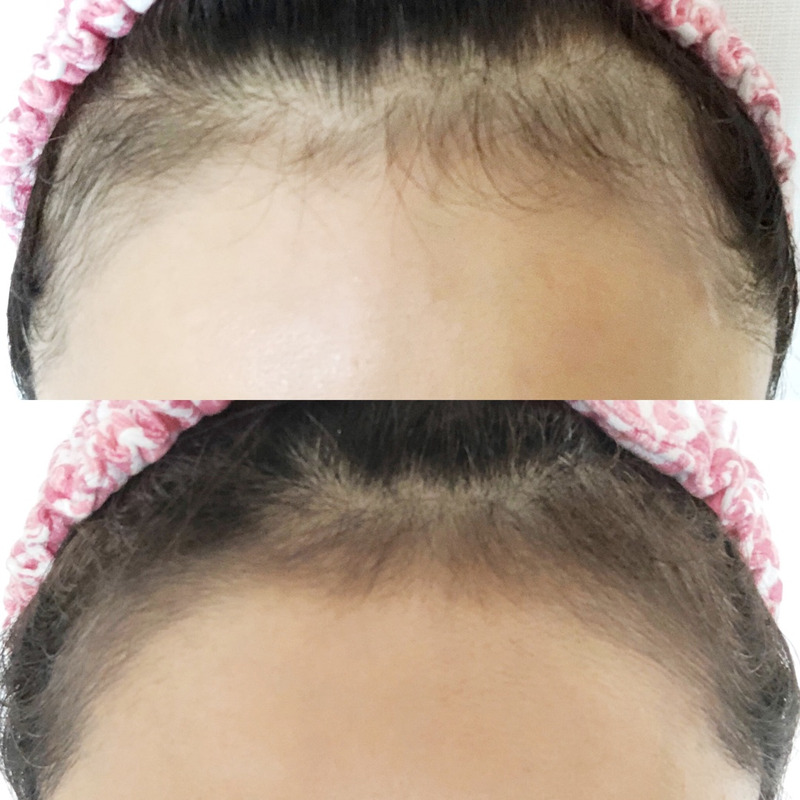 更年期女性の毛髪変化 生え際が気になる私へ 薄毛に悩むサプリメントアドバイザーが選ぶ成分ミレット L リジンとは 日経xwoman Terrace